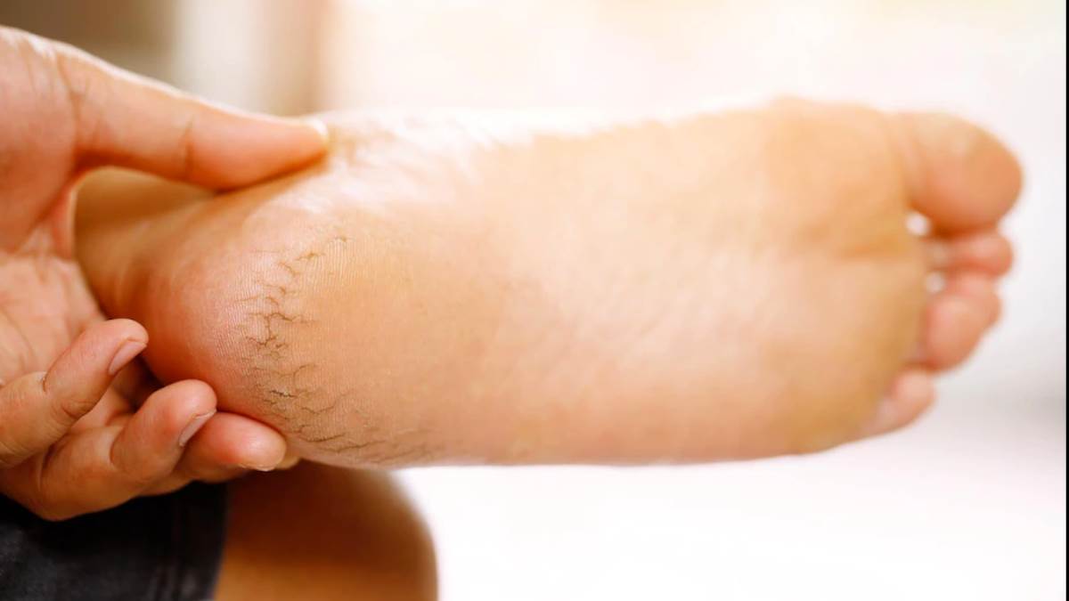 cracked heels remedy for foot soak