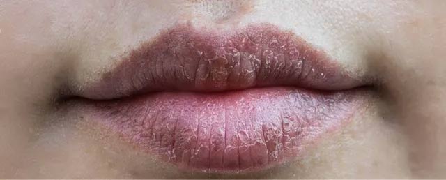 micropigmentation problem in lips