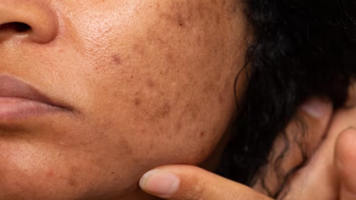 what is hyperpigmentation