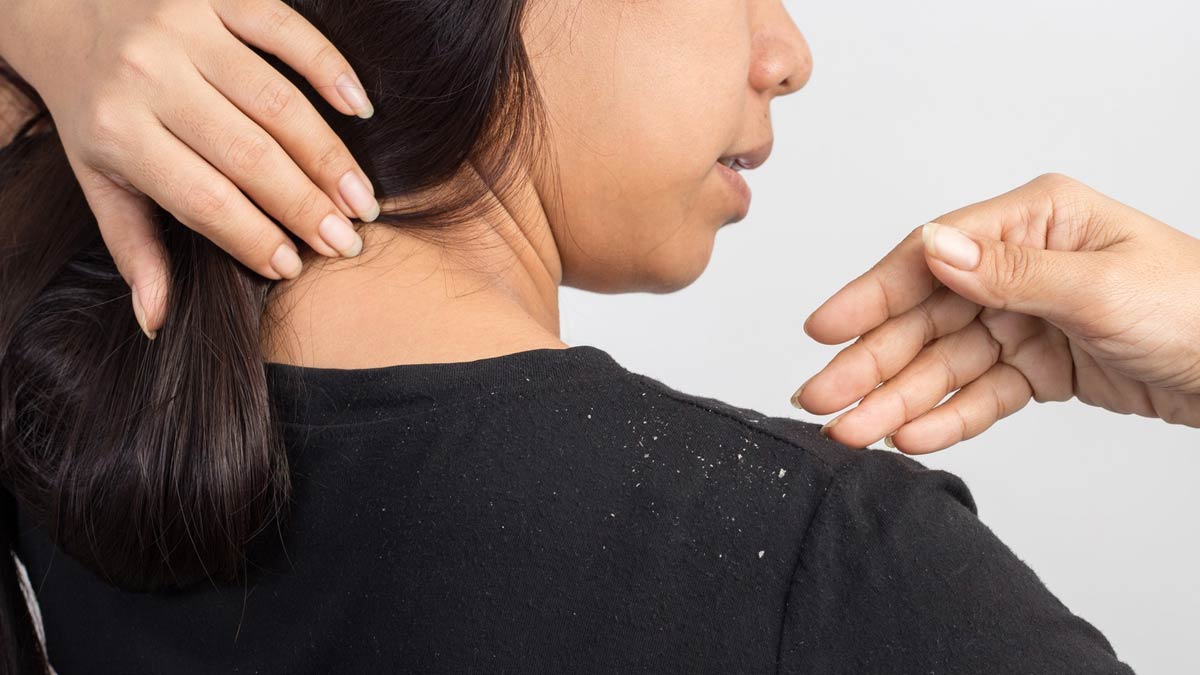 dandruff tips to remember
