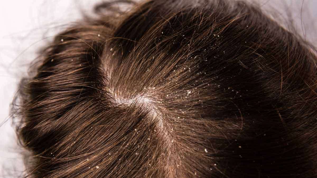 hair mask for dandruff removal