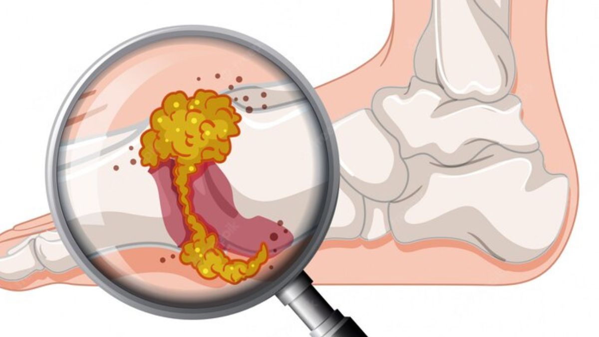 what is uric acid