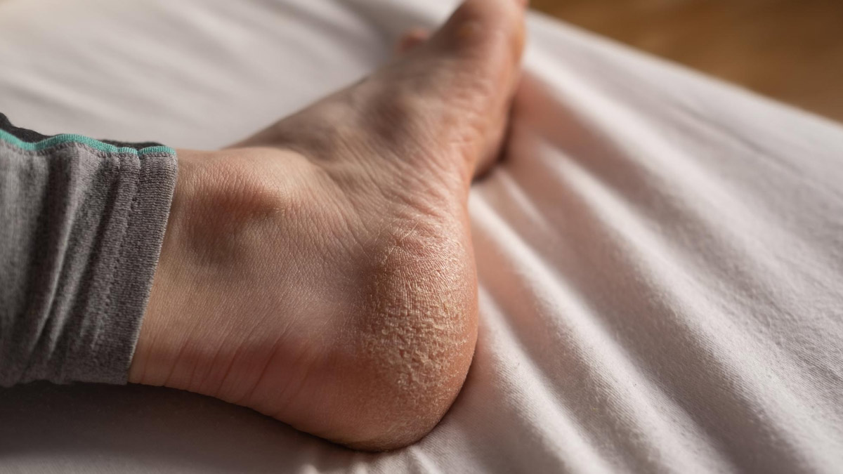 cow ghee for crcaked feet