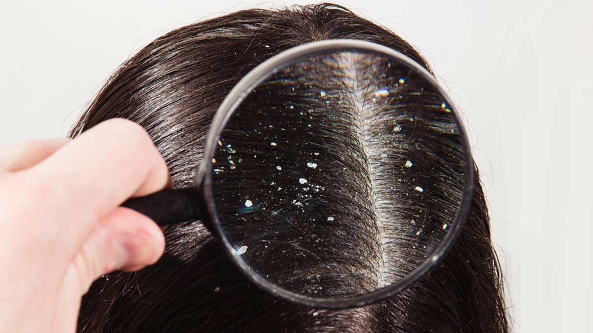 what are the causes of dandruff