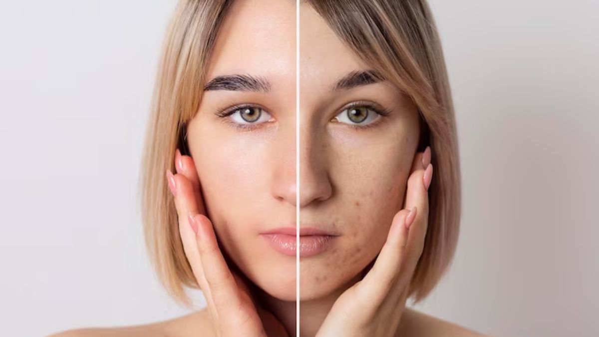 clove face pack pimple