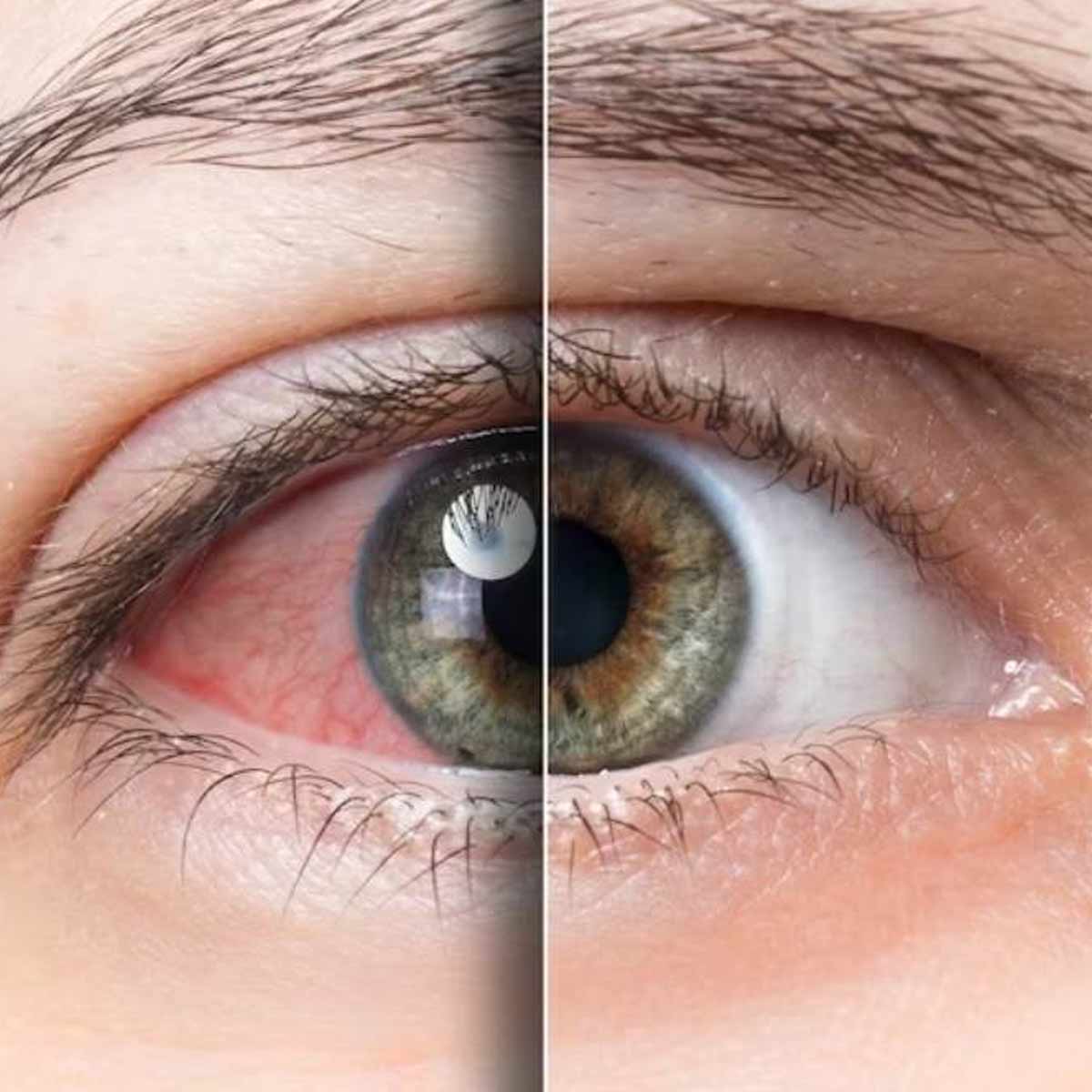 eye problems and conjunctivitis