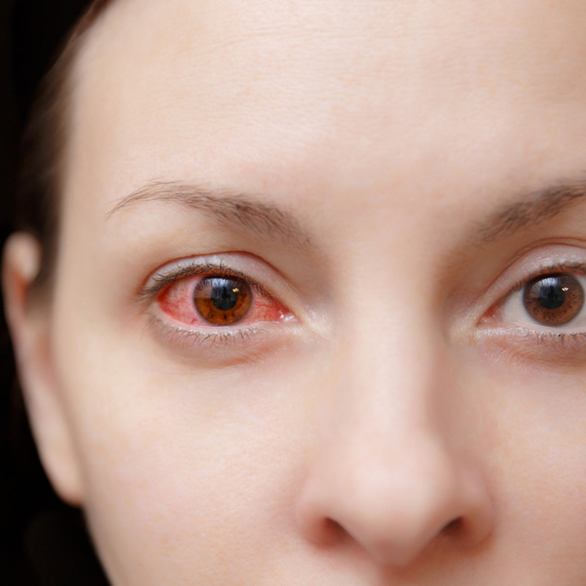 what is conjunctivitis aka pink eye