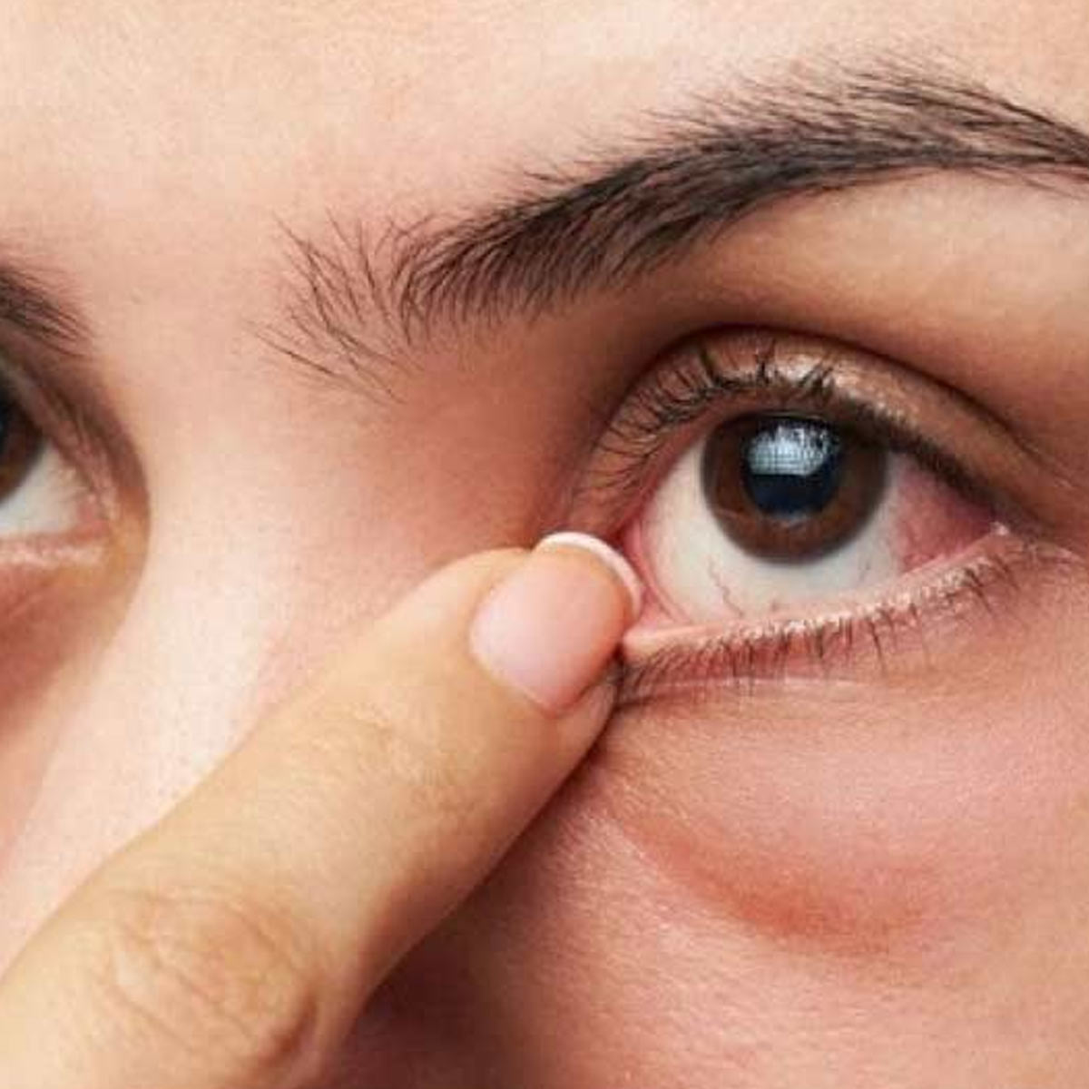 what to do if you have conjunctivitis
