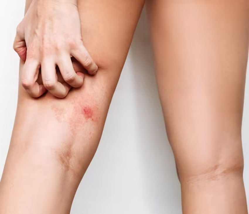 can tight jeans causes rashesh