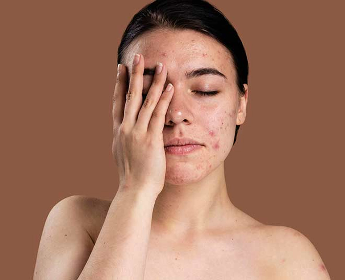 how to use rice flour for pimples