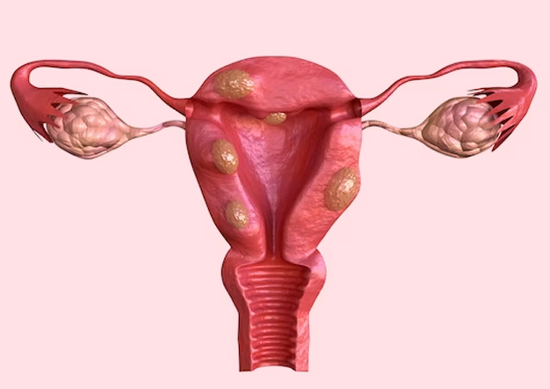 uterine fibroid causes