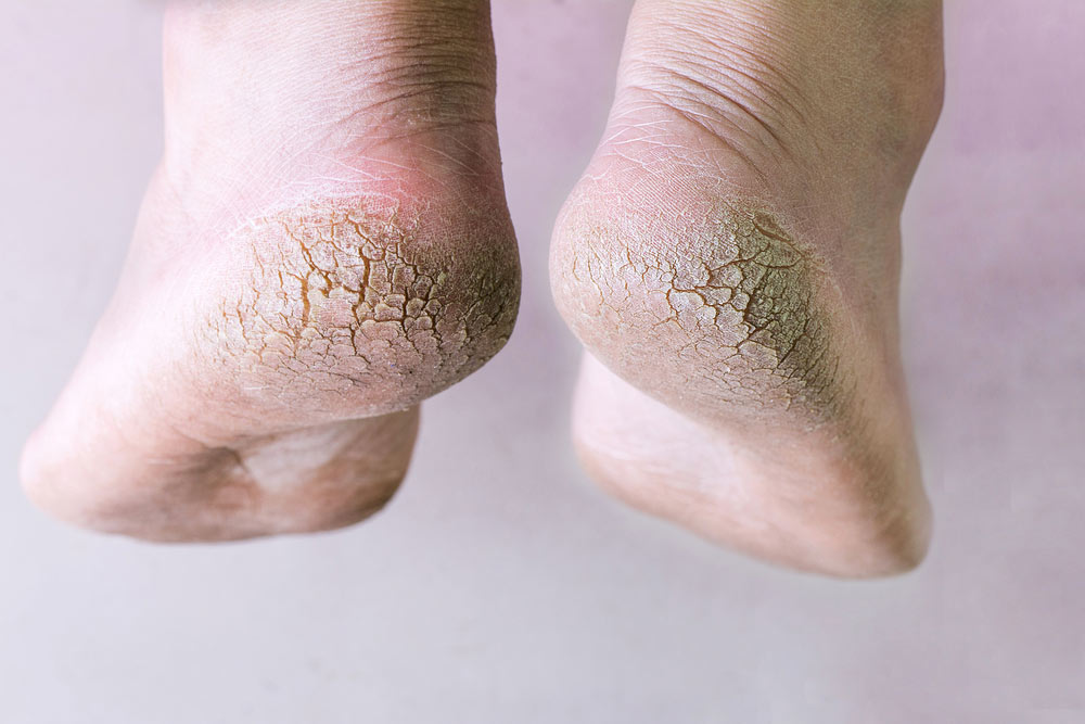 cracked heels