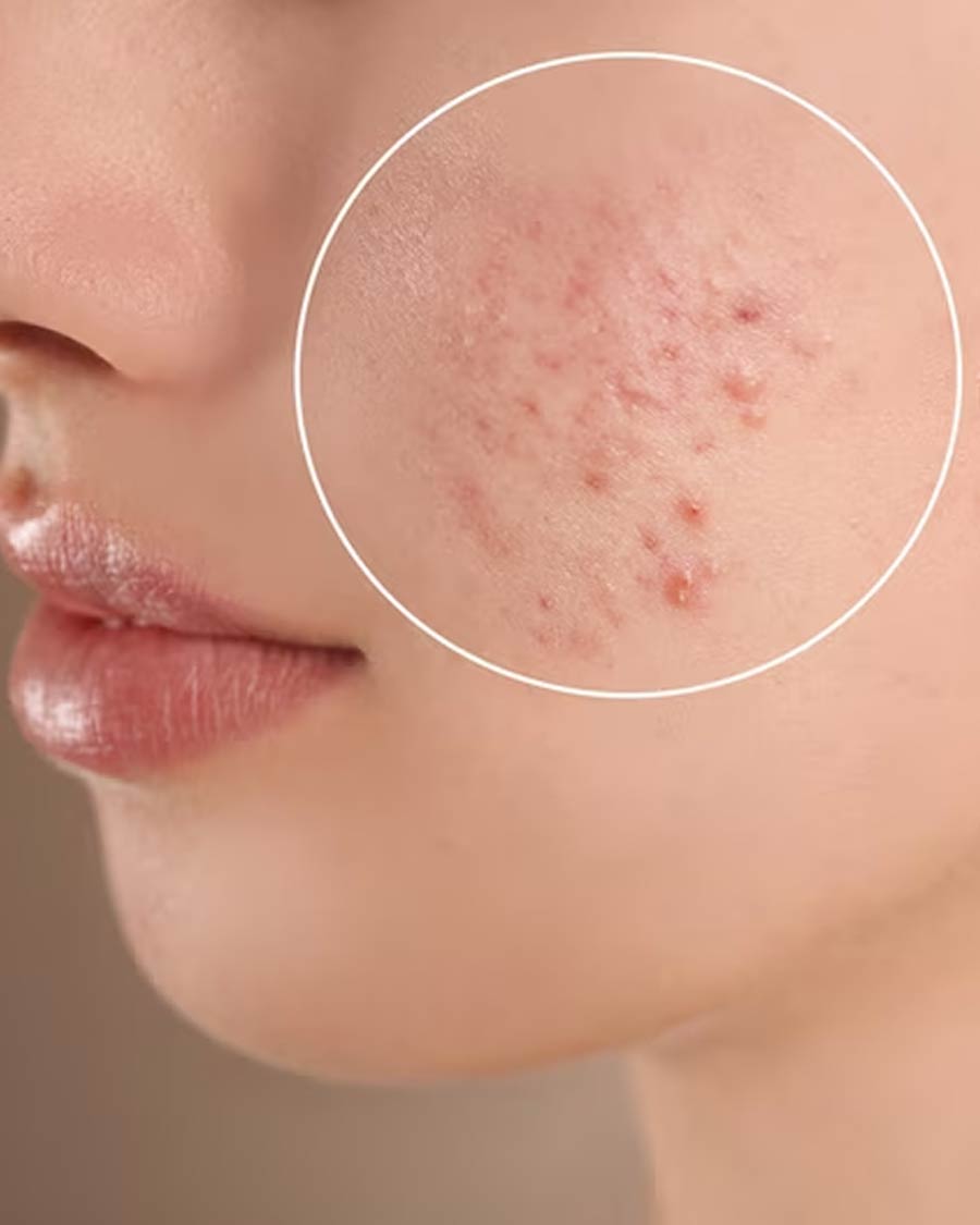 large pores on face home treatment in week