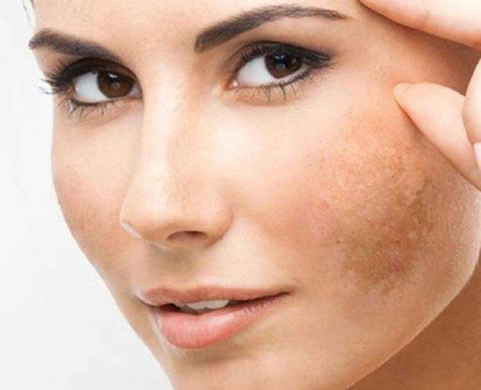 causes of hyperpigmentation