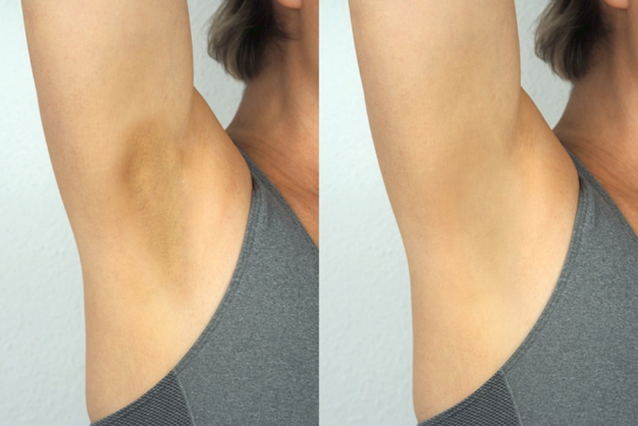 black underarms treatment