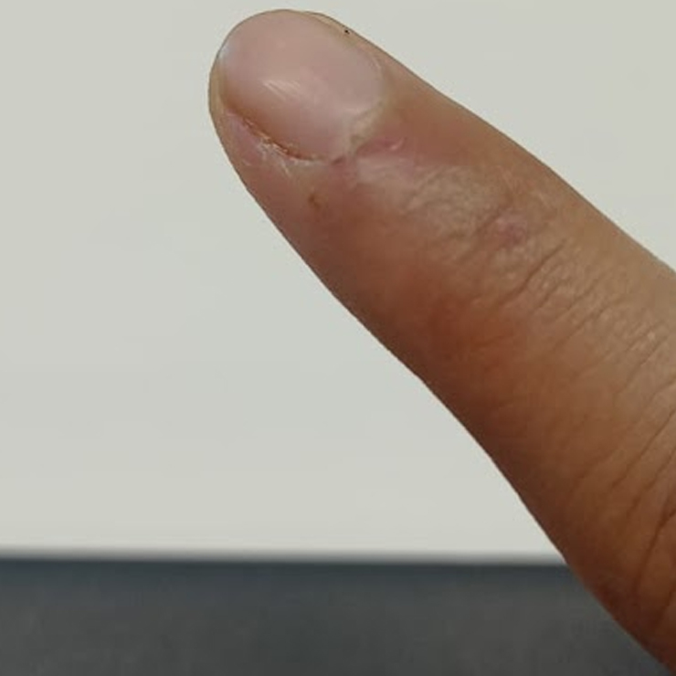 biting nails could be the reason of skin peeling