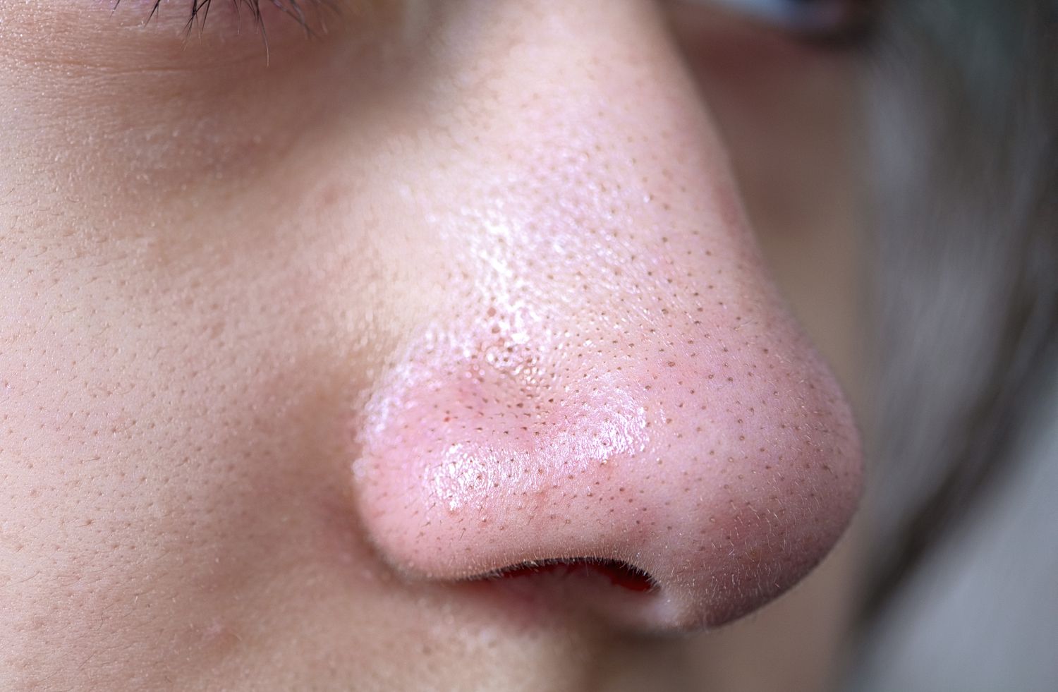 blackhead