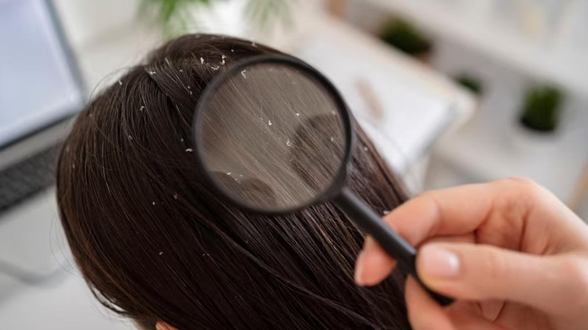 how to get rid of dandruff