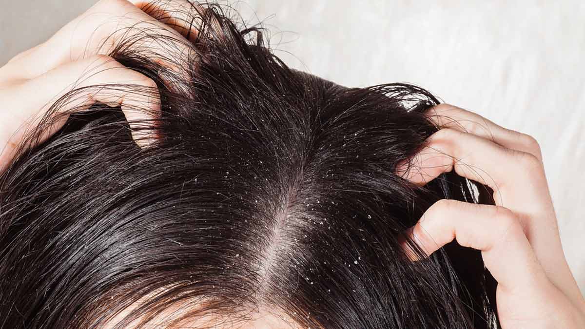 dandruff problem