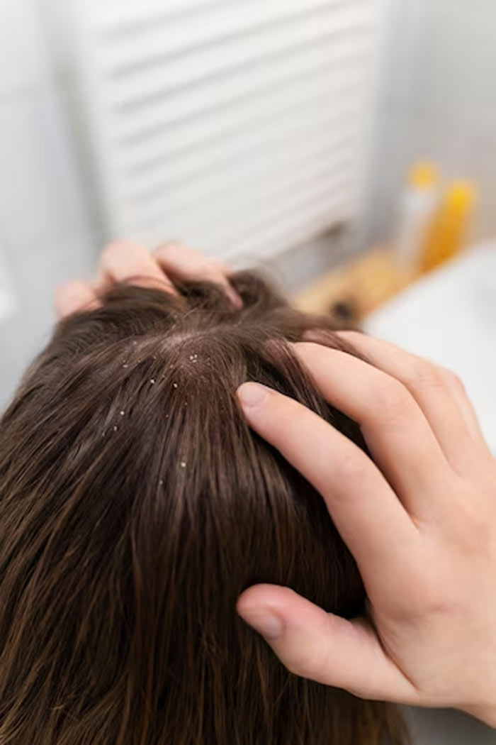 Dandruff for hair care