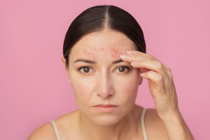 forehead pimple inside