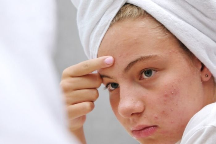 forehead pimple new inside