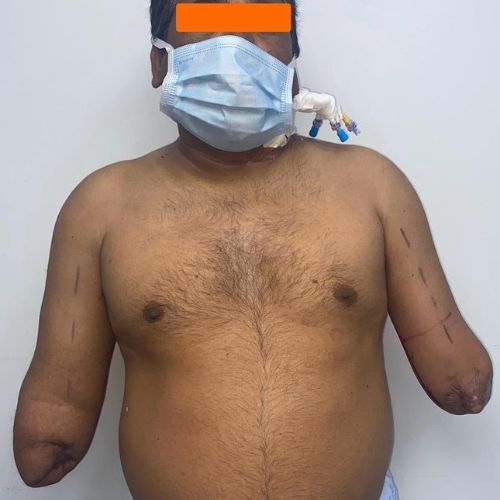 Bilateral hand surgery