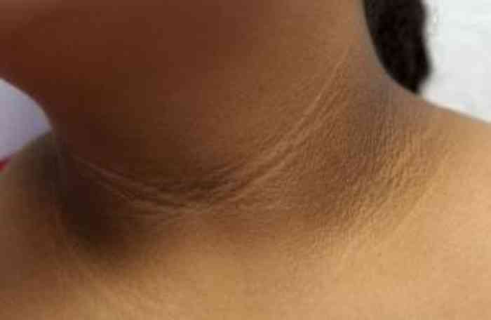 home remedies for dark neck