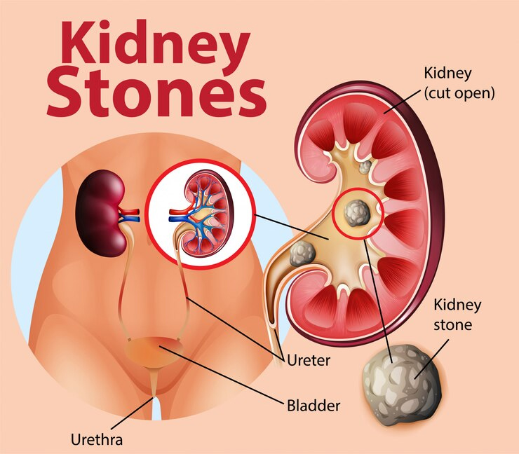 natural remedies for kidney stones