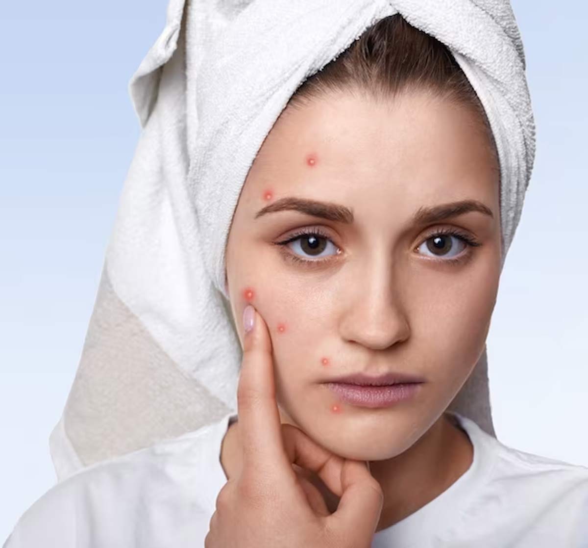pimple marks treatment