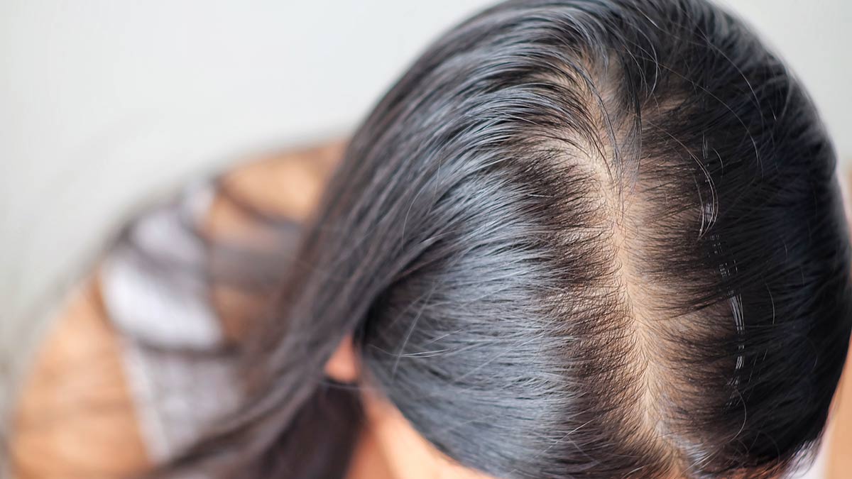 hormonal imlabance and hair fall
