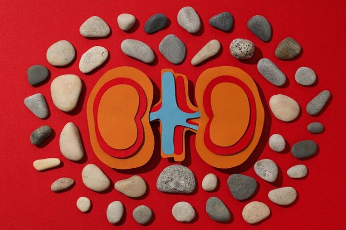 kidney stones inside