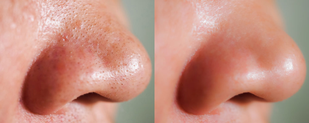 nose blackheads removal new