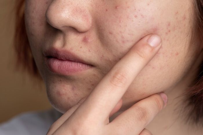 acne spot inside