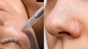 How To Get Rid Of Blackheads?