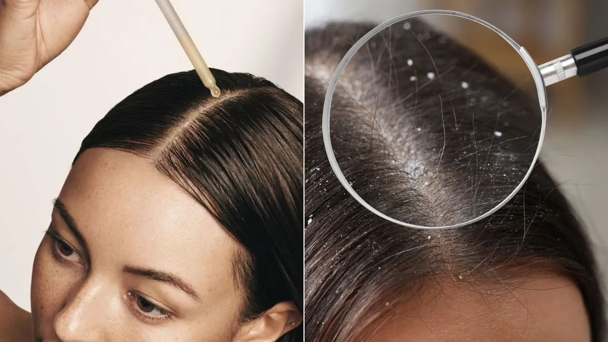 Anti Dandruff Serum For Hair