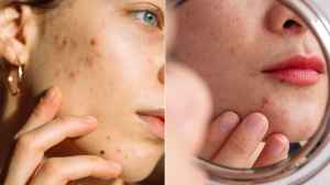 Acne Marks Removal Cream