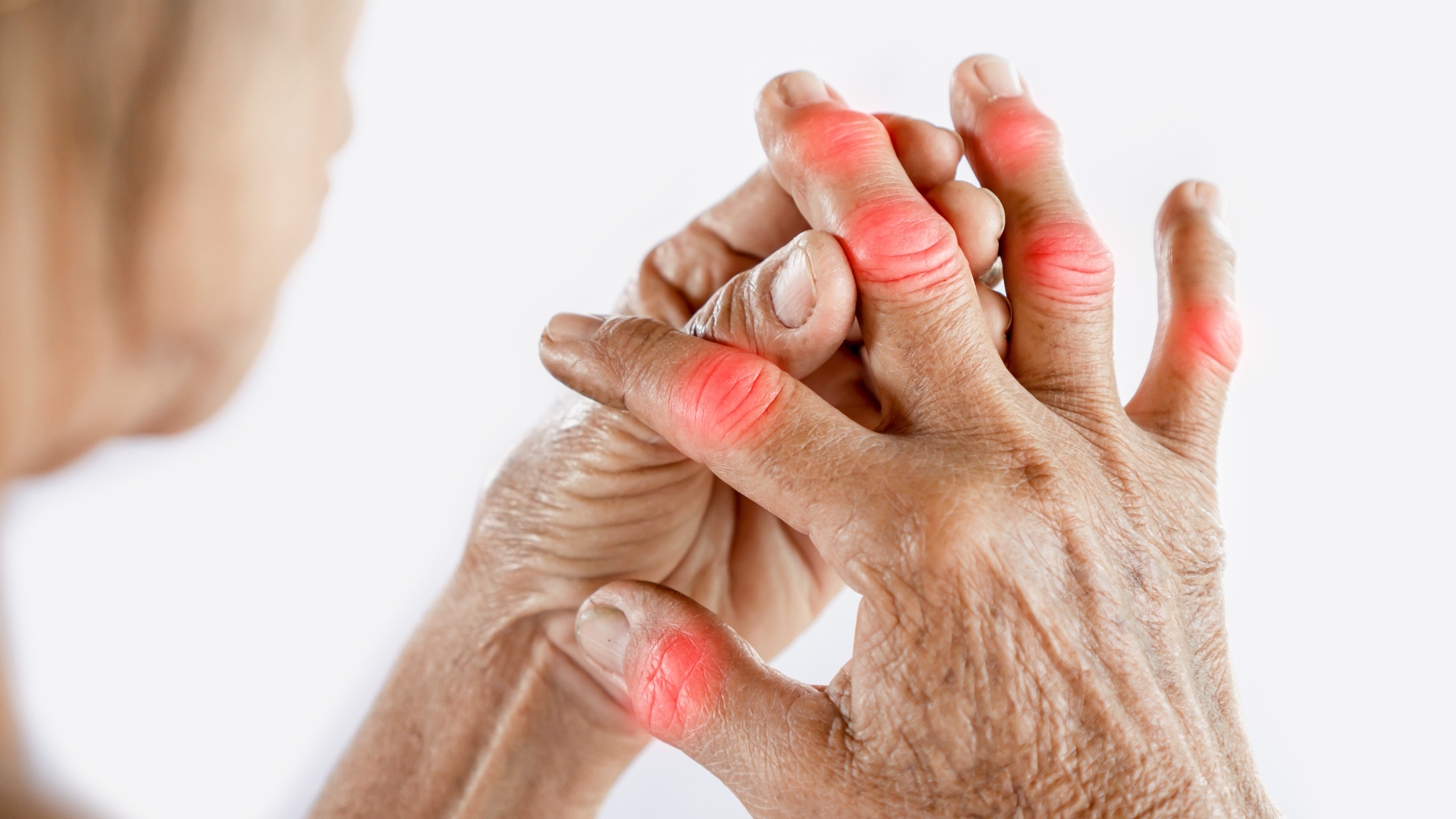 World Arthritis Day 2024 Why Does It Affect Women More? Expert