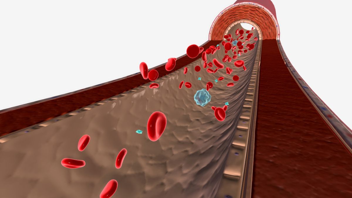 risk of deep vein thrombosis (DVT)