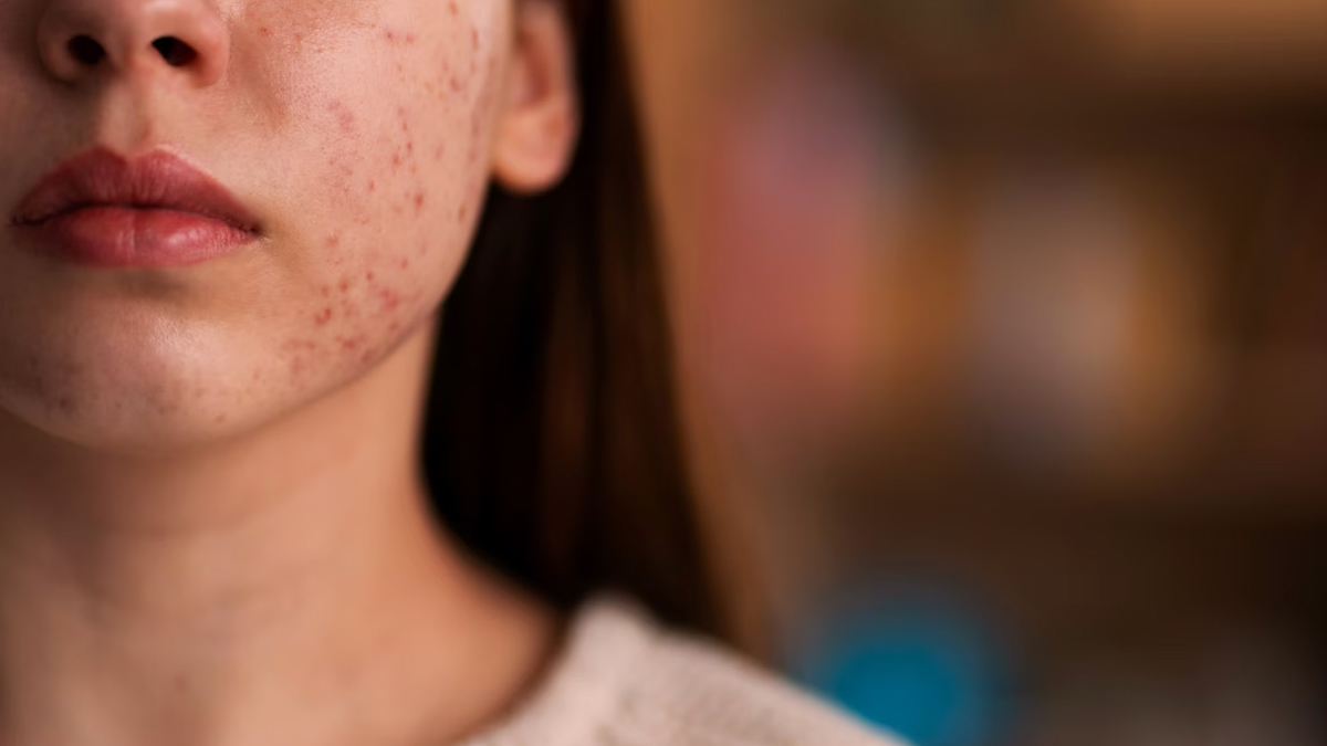 Natural Remedies To Treat Acne
