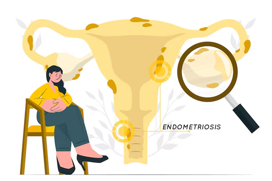 causes of endometriosis