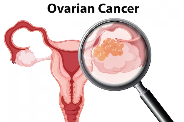 Ovarian Cancer Symptoms And Prevention Tips