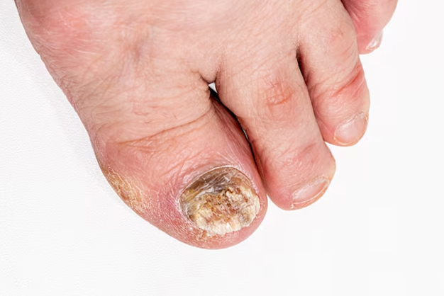 6 signs of diabetes in feet