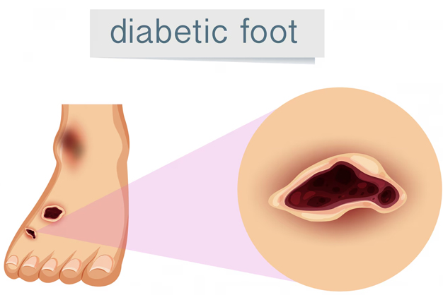 signs of diabetes in foot