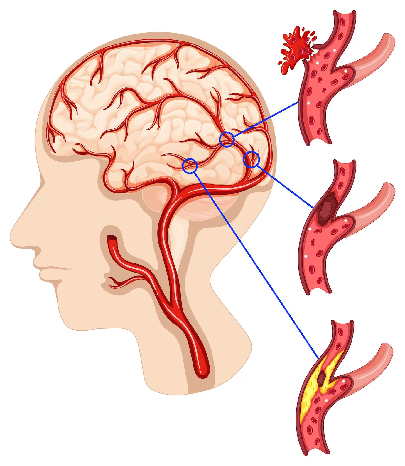 Warning Signs Of Brain Aneurysms