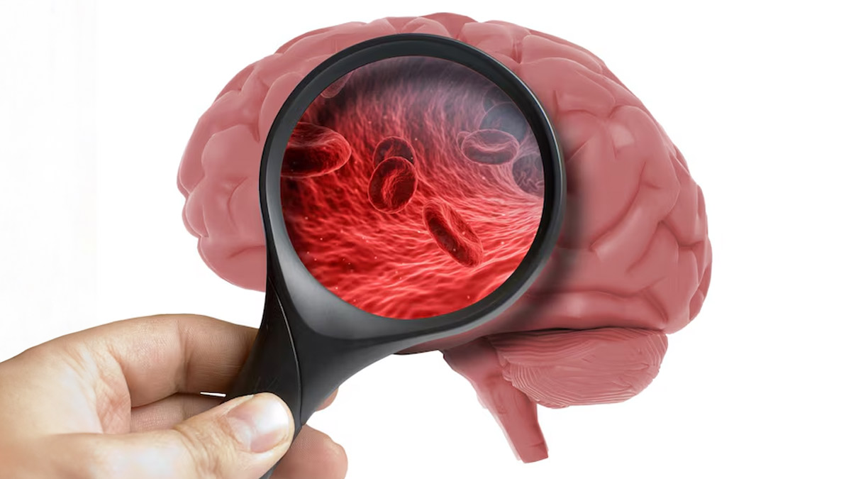 5 Early Symptoms of Brain Cancer: How to Spot the Signs