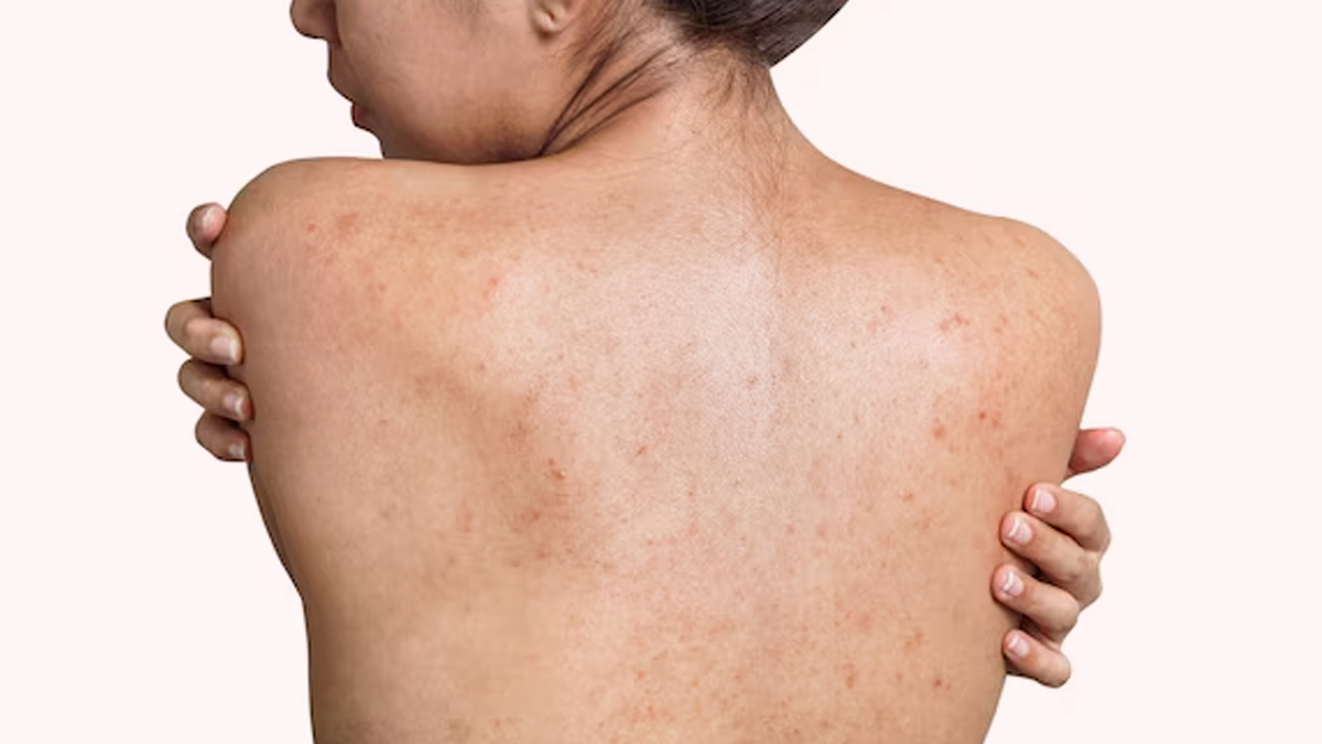 How To Get Rid Of Back Acne? Best Tips To Remove Bacne