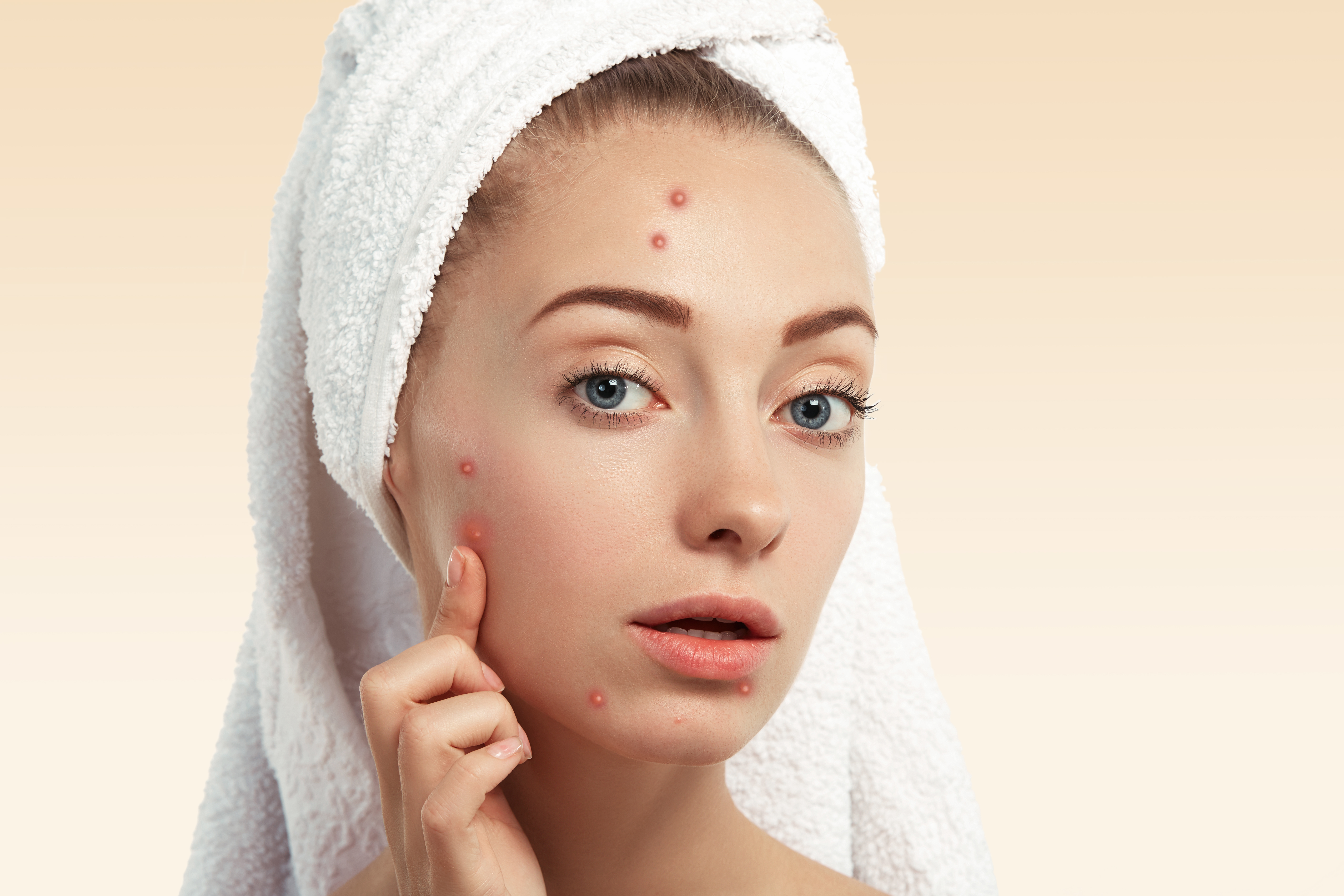 closeup-young-woman-with-towel-head-pimples-face