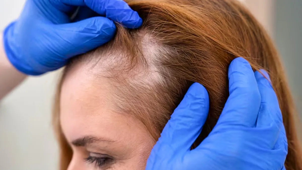 daily mistakes that are making you go bald faster