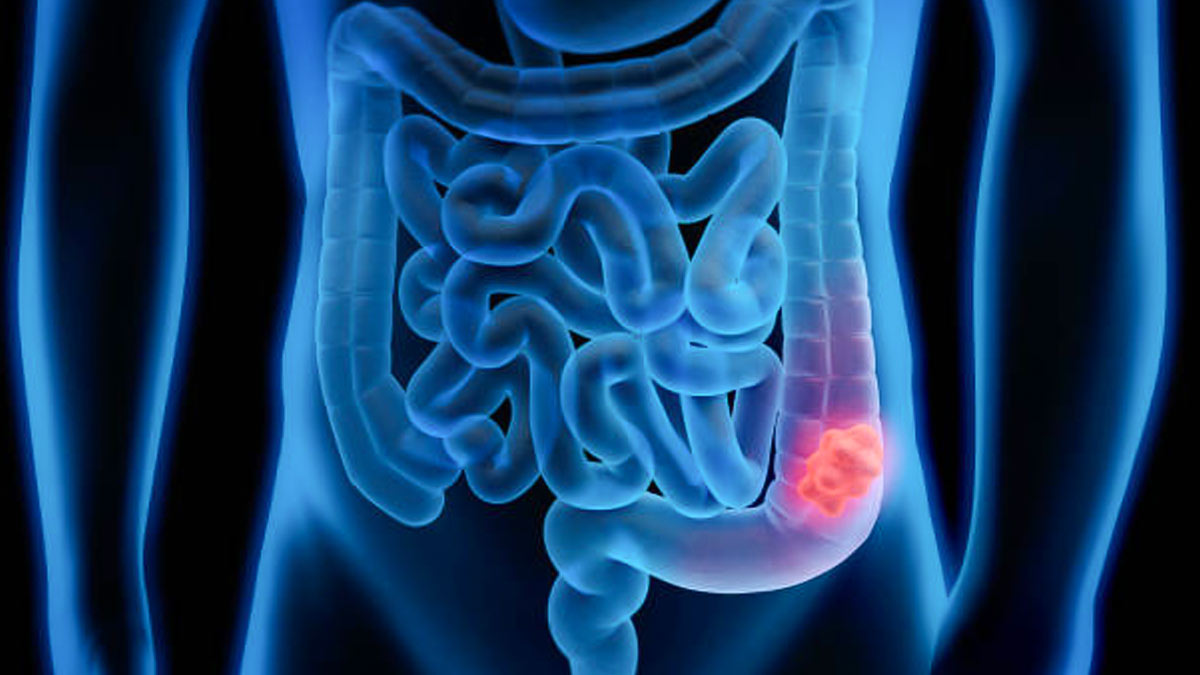 Blood in Stool: Why It’s the Most Missed Sign of Colorectal Cancer (Expert Explains)